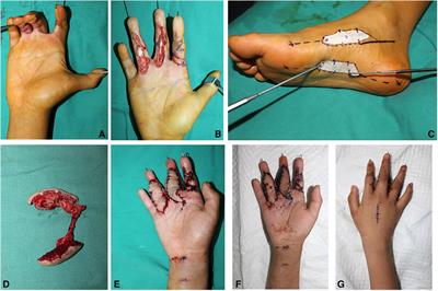 Medial plantar artery perforator (MPAP) flap is an ideal option for reconstruction of complex soft tissue defect in the finger: Clinical experience from 11 cases